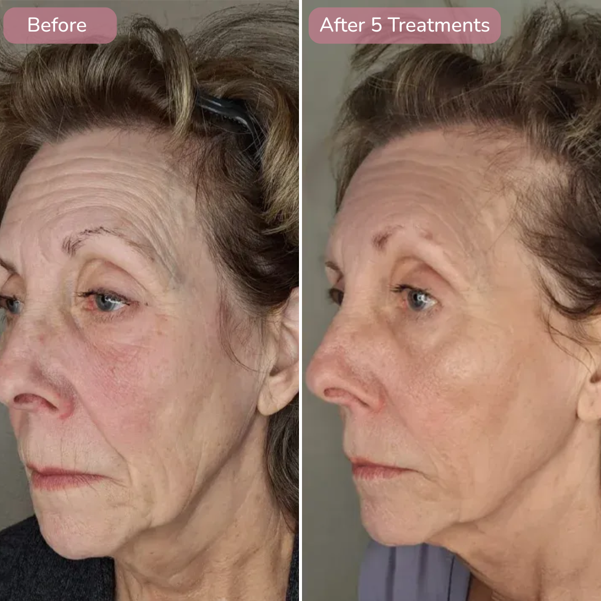 Age Backwards With DermaInfuse