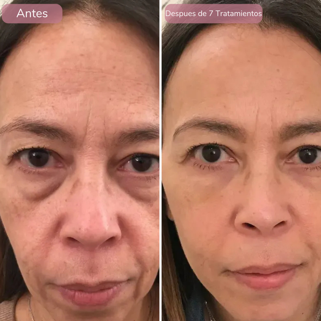 Rejuvenece Tu Piel Con DermaInfuse