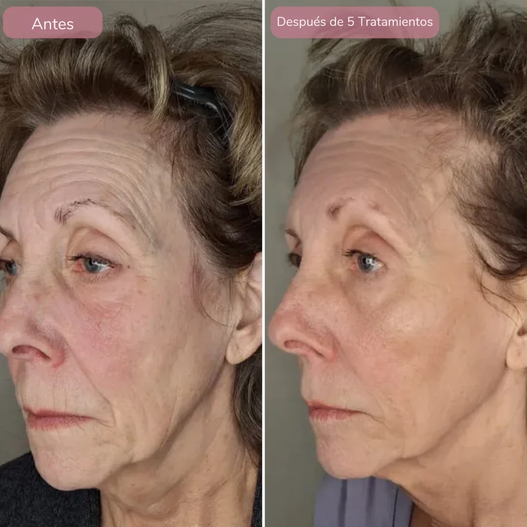Rejuvenece Tu Piel Con DermaInfuse