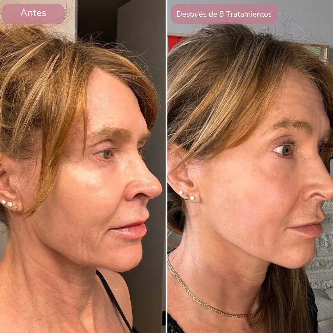 Rejuvenece Tu Piel Con DermaInfuse